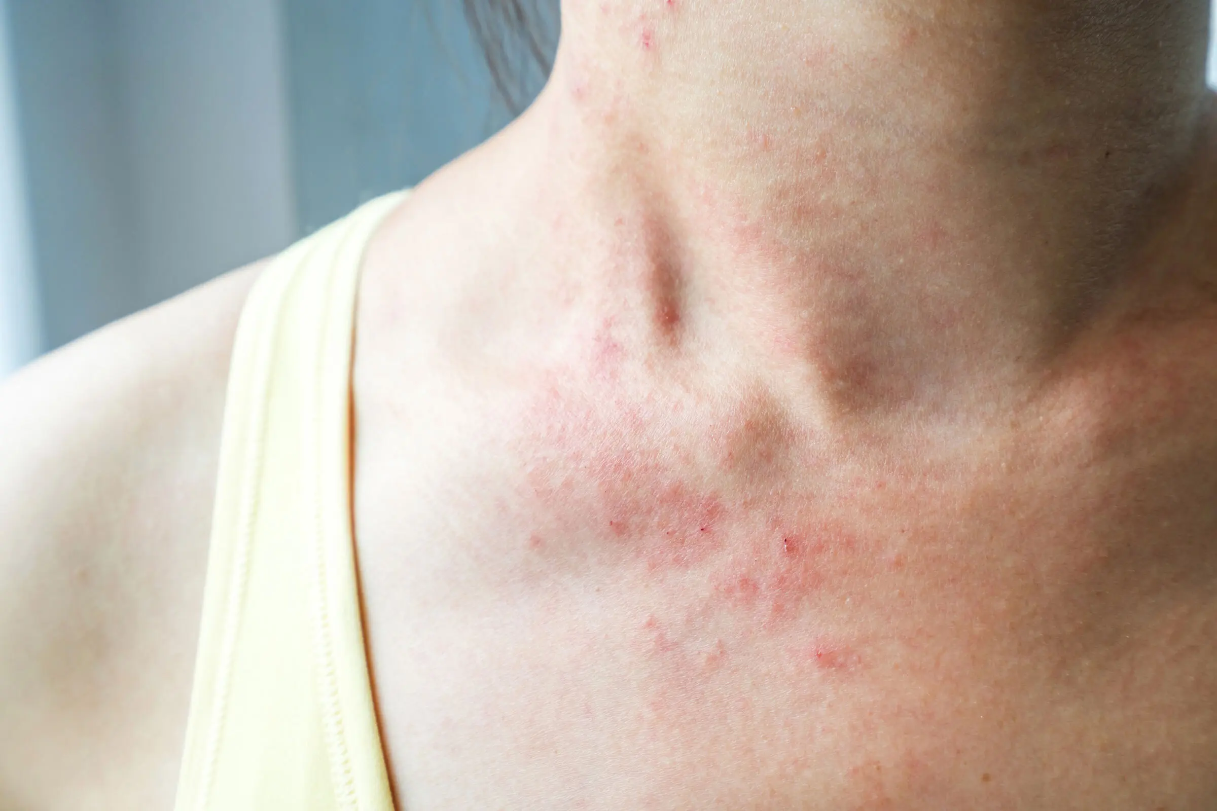 Close-up of a person's neck and upper chest showing red, inflamed skin, typical of eczema.